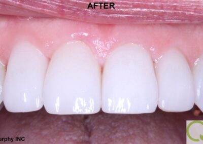 new westminster veneers