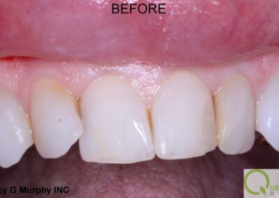 new westminster veneers