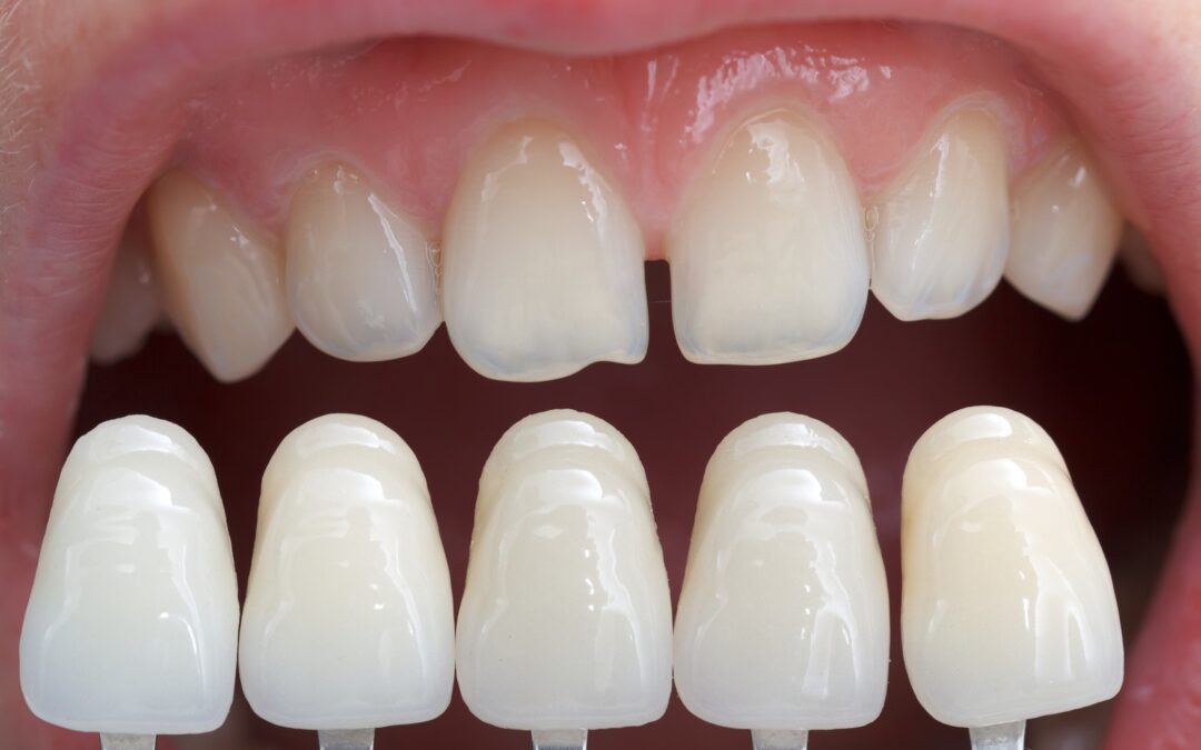 What are Veneers?