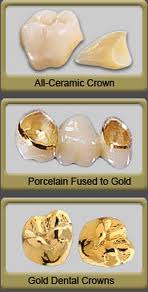 3-types-of-dental-crowns