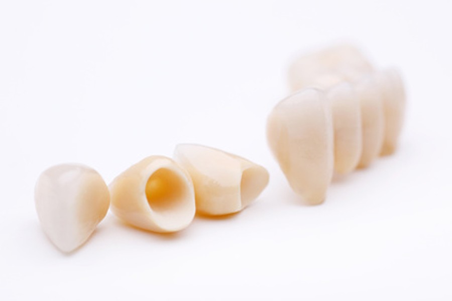 What are Dental Crowns?