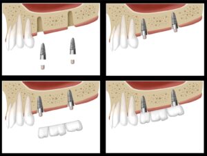 implantin new westminster