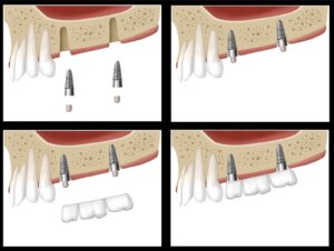 implantin new westminster