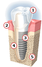 dental-implant - Queen’s Park Dental dental-implant