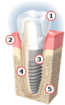 dental-implant