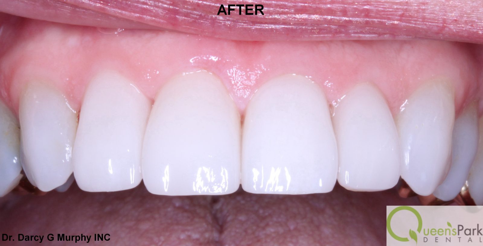 new westminster veneers