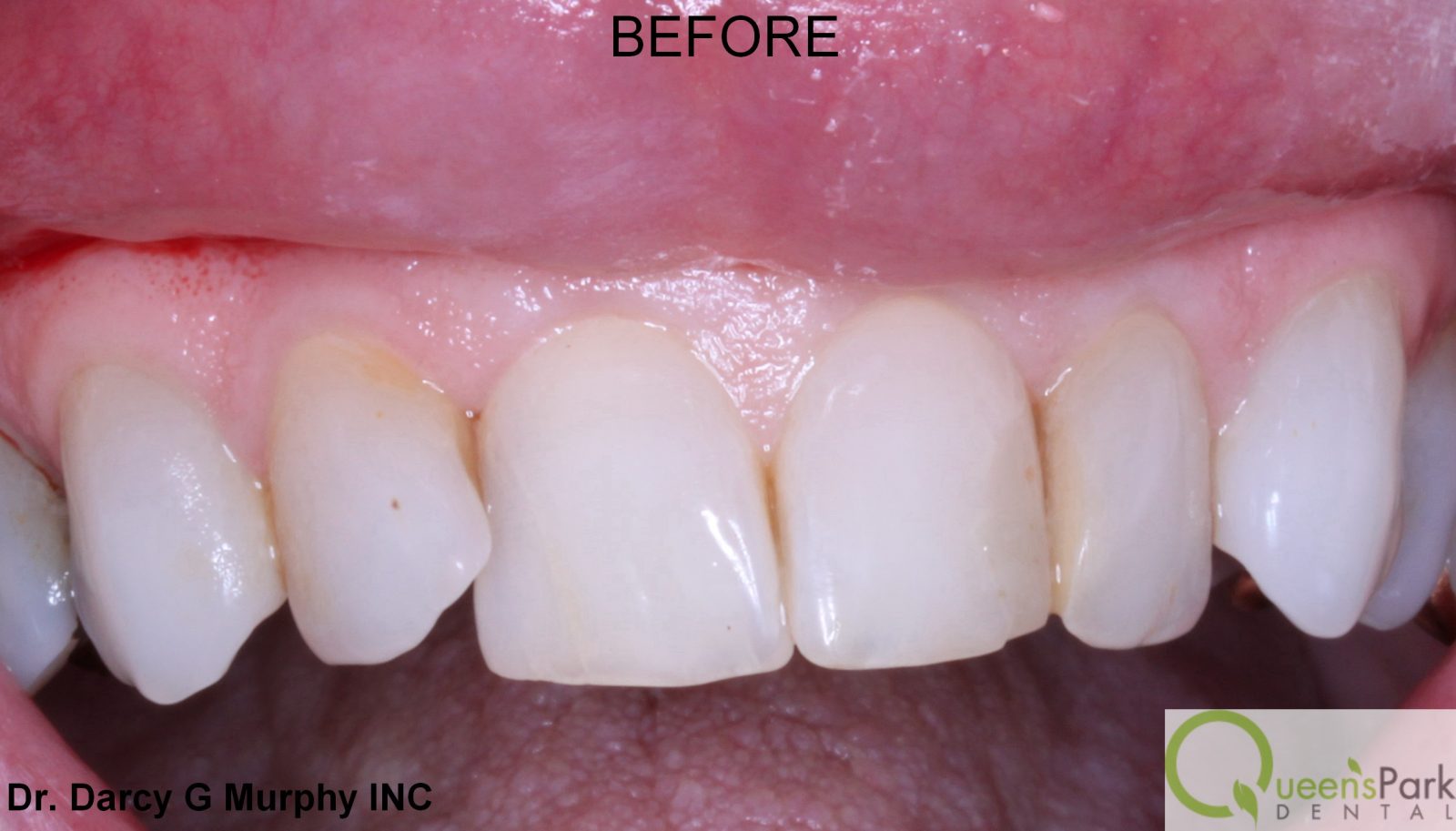 new westminster veneers