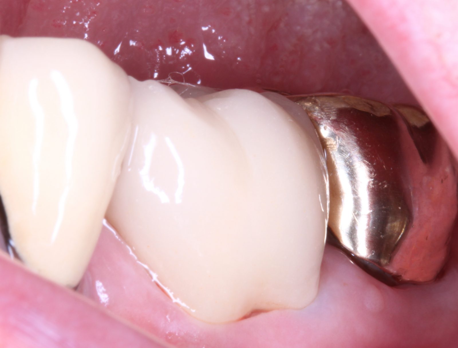 new westminster dental crowns