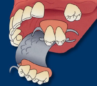 removable-partial-denture-top