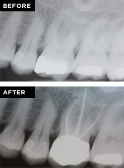 root-canal