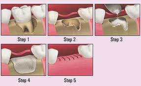 bone-grafting