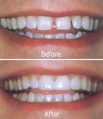 crowns before and after