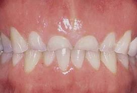 damaged-teeth-from-grinding