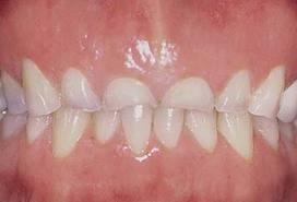 damaged-teeth-from-grinding