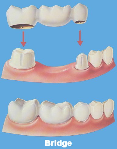 dental_bridge - Queen’s Park Dental dental_bridge
