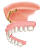 implant-retained-upper-denture