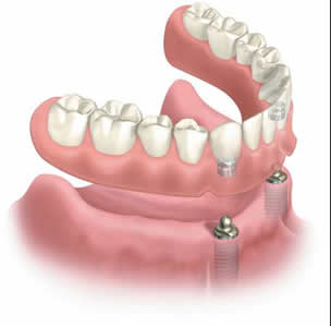 implant-supported-denture-lower