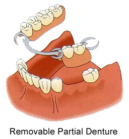 removable-partial-dentures