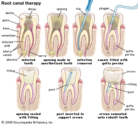 root-canal-therapy