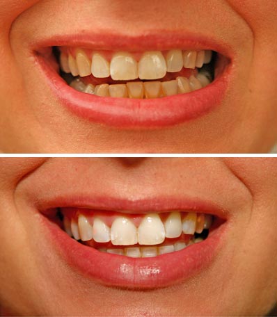 teeth-whitening