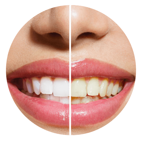 teeth-whitening