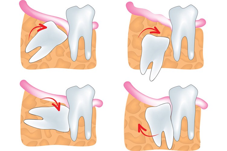 wisdom-teeth