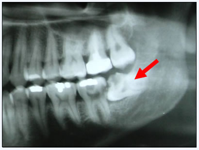 wisdom-tooth-extraction