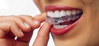 Achieve a Confident Smile with Invisalign in New Westminster at Queen’s Park Dental