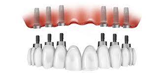 Implant retained Bridge