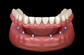 Implant retained denture