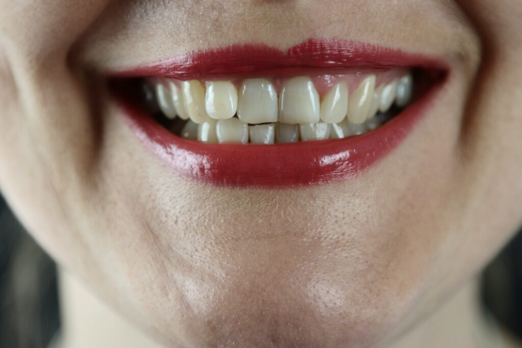 Queen's Park Dental Invisalign Crooked Teeth